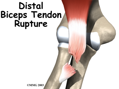Distal Bicep Tendon Rupture